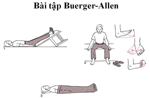 Bài tập Buerger Allen cho bệnh nhân giãn tĩnh mạch chân