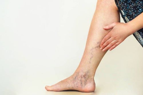 Tỷ lệ mắc giãn tĩnh mạch chân ở nữ giới cao gấp 3 lần nam giới