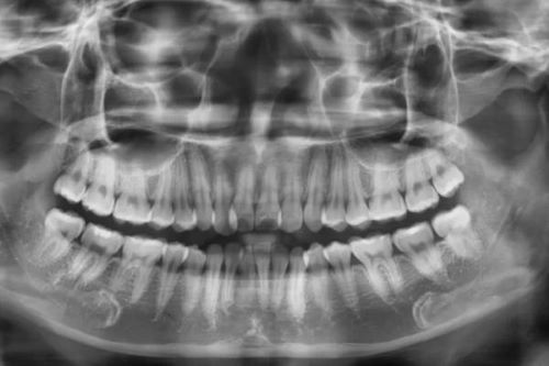 Chụp X-quang răng là bước đầu tiên trong quy trình nhổ răng