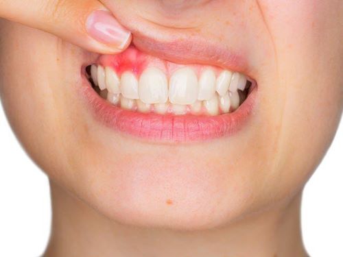 Chống chỉ định nhổ răng khi đang viêm lợi